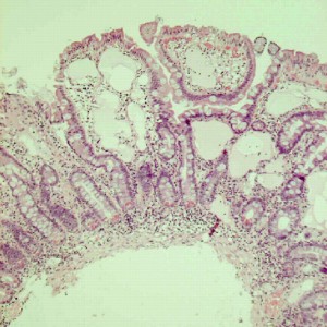 Canine Intestinal Lymphangiectasia 102: « Louie the Love Muffin